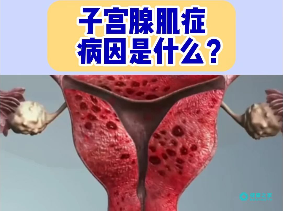 子宫腺肌症
