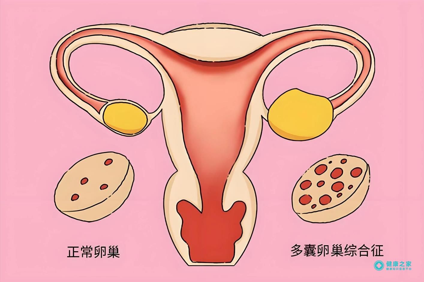 多囊卵巢综合征.jpg